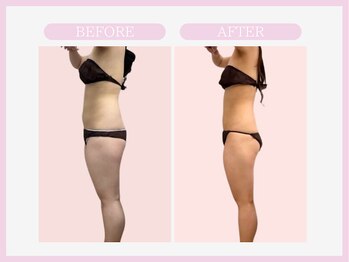 スリムライン 青森店(The Slim Line)/before→after