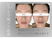 脂肪ヒアルでコケ改善！ゴツゴツ感から柔らかな女性らしい印象へ