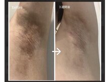 ファースト(1st)/ローマピンク【脇・ワキ】