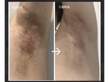 ファースト(1st)/ローマピンク【脇・ワキ】