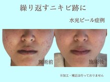 プレリー 自由が丘店/水光ピールスキン