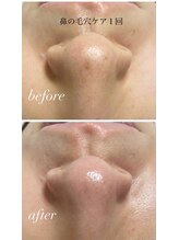 サロンドシェリ(salon de cheri)/毛穴黒ずみスッキリ！