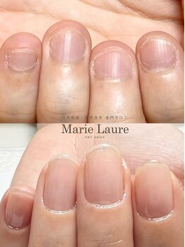 マリーロール 梅田店(Marie Laure)/自爪育成/深爪矯正/ネイルケア