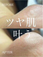 アイラッシュサロン ウェリナ 名古屋(Welina)/脱毛/産毛ケア/毛穴/美肌/肌荒れ