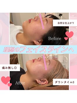 ウナ デ リンゴル 恵比寿店(UNA de Ringol)/Wアタック究極小顔¥13,500