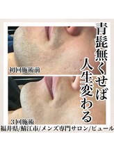 ピュール 鯖江店(PUR)/【圧倒的人気！】ヒゲ全体脱毛
