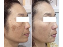 ベレザ(Beleza)の雰囲気（結果重視！しみ、しわ、たるみ、毛穴、にきび★肌別フェイシャル）