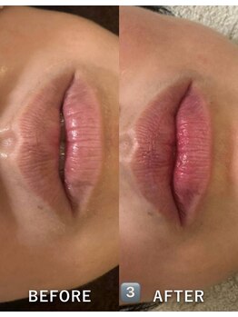 メディカルエース(MedicalAce)/ROMA　PINK