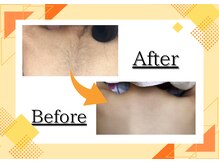 アルゴ 西鉄香椎駅前店(ALGO)/背中脱毛♪