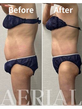 エアリアル 筑紫野店/ガンコなお腹周りにも脂肪冷却！