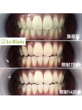 ルブラン 奈良店(Le Blanc)/回数重ねてどんどん白く！