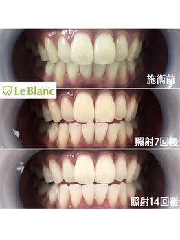 ルブラン 奈良店(Le Blanc)/回数重ねてどんどん白く！