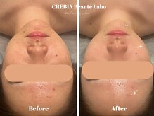 クレヴィア バイ サイバーエステ(CREBIA)