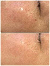 ニジ(Nizi)/毛穴をきゅっと引き締め肌へ