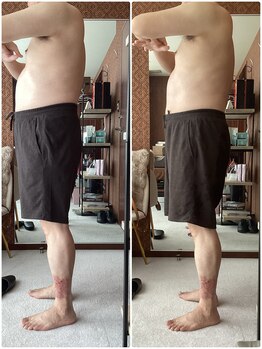 フォルトゥーナ ビューティー(Fortuna Beauty)/キャビゼロ施術