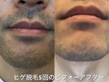 ティーナ(Teena)の雰囲気（毎朝の面倒な髭剃りから卒業◎ヒゲ脱毛のビフォーアフターです♪）