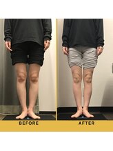 ベル/【20代会員様】O脚矯正の変化