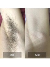 サロンリアンジュ ひたちなか店(Salon Liange)/脇脱毛◇ニオイの原因を排除！