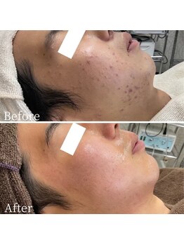 ニキビケア 毛穴研究所 立川店/メンズニキビでお悩みの方へ
