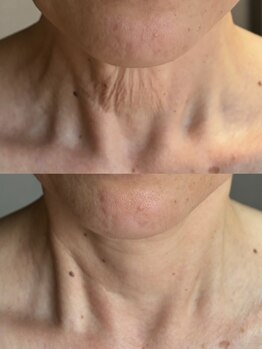 サロンドミュウ(Salon de Mieux)/【シワ】でお悩みのお客様