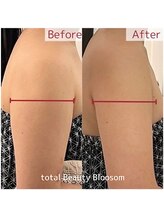 Blossom 【ホワイトニング/脱毛/韓国肌管理/毛穴洗浄】【3/23 NEW OPEN(予定)】/REDSHOT　二の腕