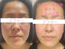 サクラ(SAKURA)/【スーパー小顔】の効果半端ない