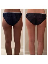 ルナスーリヤ 表参道店/痩身before　after