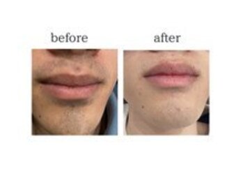 プリズム/男性ヒゲ脱毛のビフォーアフター