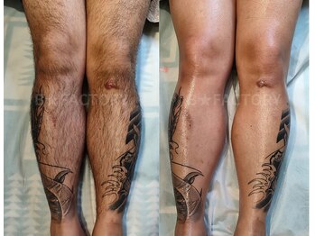 ビー ファクトリー(B FACTORY)/メンズ　脚ワックス　