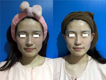 プリオール 高崎店(Prior)/小顔コルギ