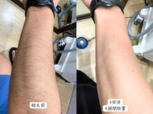 セルフメイド 東大阪店(SELFMADE)/腕脱毛のビフォーアフター♪