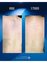 ルミーク(Lumique)/背中 17回目 症例　W様