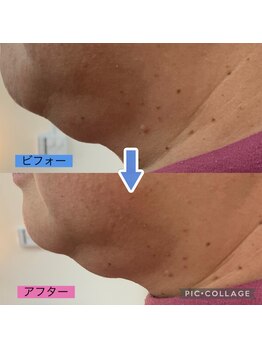 ニコ(niko)/顎のたるみ気になりませんか