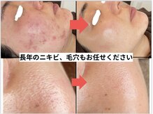 リアリア(LEALEA)/毛穴、ニキビ