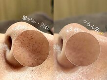 【韓国肌管理人気No,1◎】アクアピール毛穴洗浄/4,500円