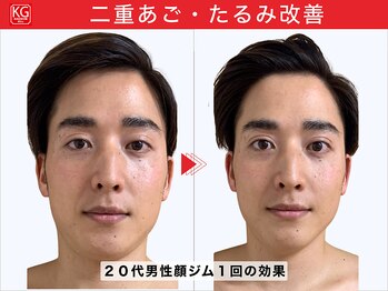 顔ジム 麻布十番店/20代男性顔ジムの効果