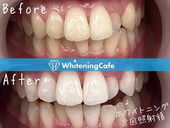 ホワイトニングカフェ 名古屋栄店(WhiteningCafe)/8回照射症例写真