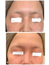 リズ(Liz)/シミケア