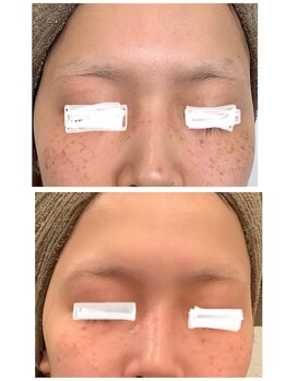 リズ(Liz)/シミケア