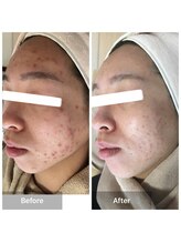 モカ 天王寺店(MOKA)/剥離3回 ニキビケア　毛穴　跡