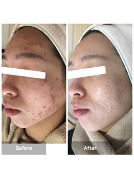 モカ 天王寺店(MOKA)/剥離3回 ニキビケア　毛穴　跡