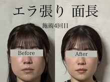 オアシストウキョウ 表参道(OASIS TOKYO)/エラ張り/面長のお悩み