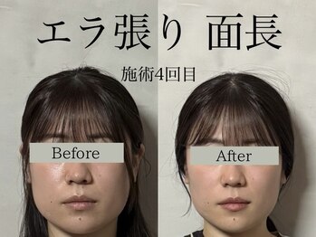 オアシストウキョウ 表参道(OASIS TOKYO)/エラ張り/面長のお悩み