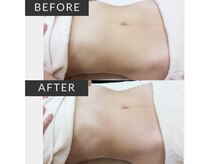 パルテール/インディバ/小顔/むくみ/高周波