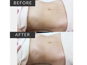 パルテール/インディバ/小顔/むくみ/高周波