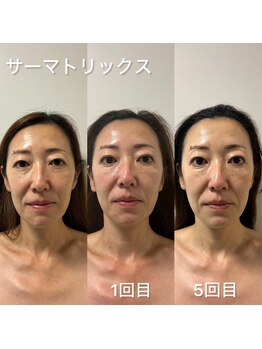 デディア 恵比寿(dedia)/サーマトリックスでたるみ解決