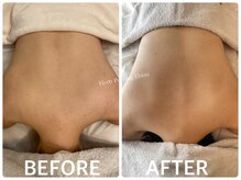 ハーブピーリング 恵比寿/背中ニキビ/引締め