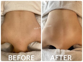 ハーブピーリング 恵比寿/背中ニキビ/引締め