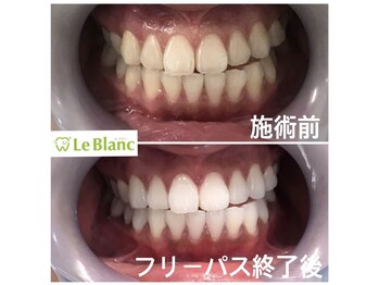 ルブラン 奈良店(Le Blanc)/白く輝く歯を目指すためにも