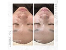 シャルムパリス(charme paris)/慢性的な赤みへ◎１回の施術変化